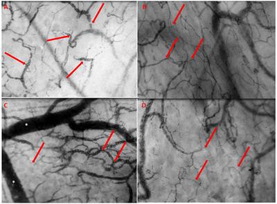 Case Report: Early Identification of Subclinical Cardiac Tamponade in a Patient With a Left Ventricular Assist Device by the Use of Sublingual Microcirculatory Imaging: A New Diagnostic Imaging Tool?